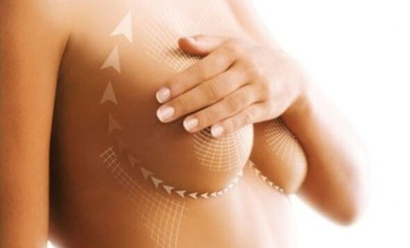 lifting stitches for breast augmentation