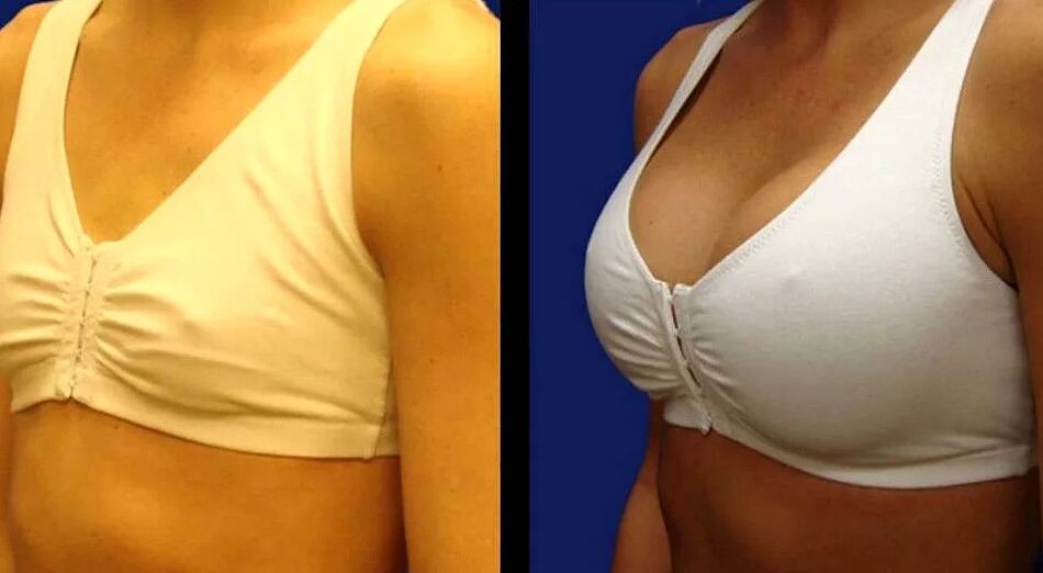 Picture of breast before and after surgery