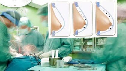 How is breast lipilifting