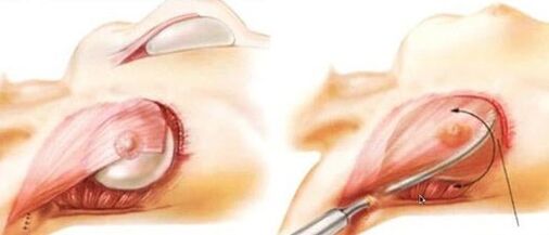 How is the breast enlargement operation carried
