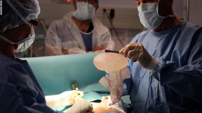 Features of mammoplast