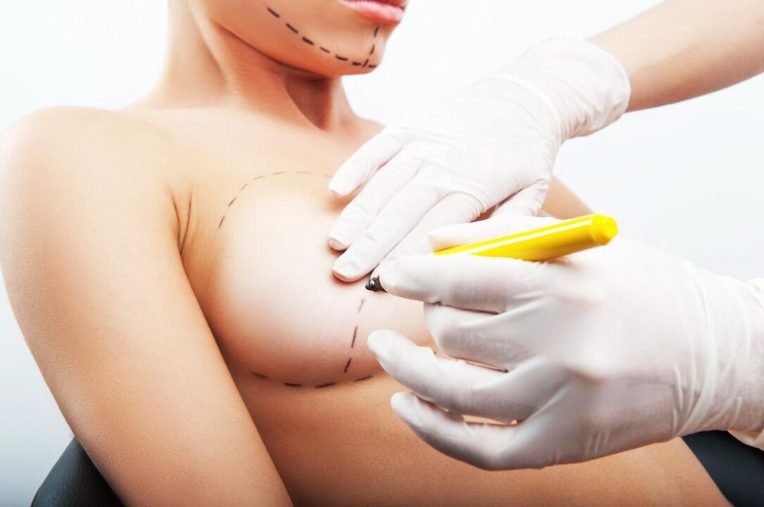 Signs before breast augmentation surgery