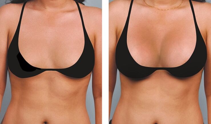 Breast augmentation before and after pictures