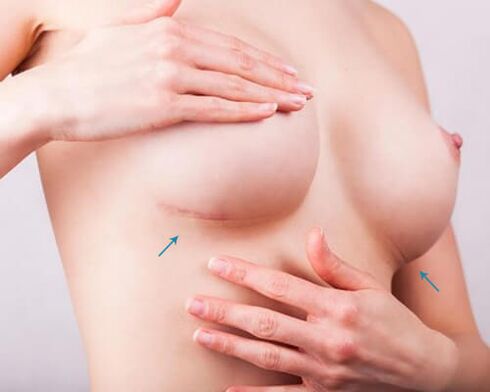 Breastlining with implants