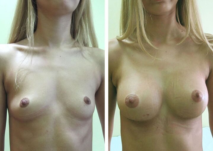 Breast before and after breast augmentation