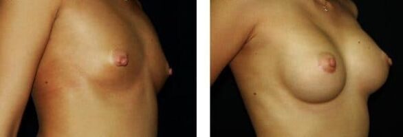 before and after breast augmentation surgery