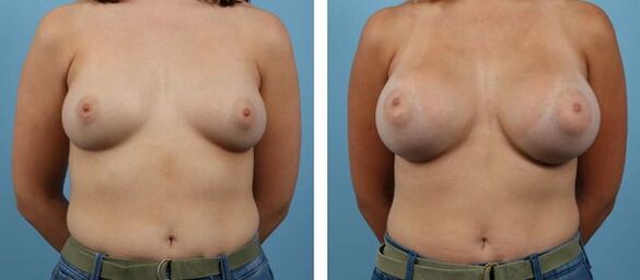 breast augmentation before and after photos