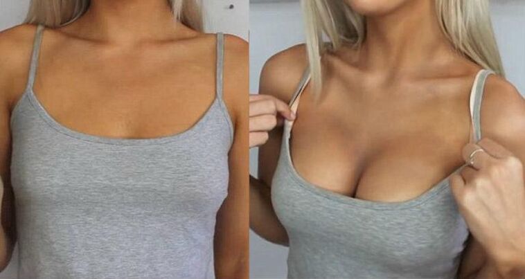 Before and after breast augmentation surgery