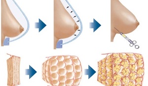 How to perform breast augmentation procedure with fat
