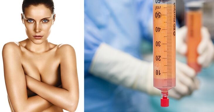 lipofilling as a breast augmentation method