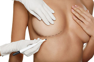 Marking before breast augmentation surgery